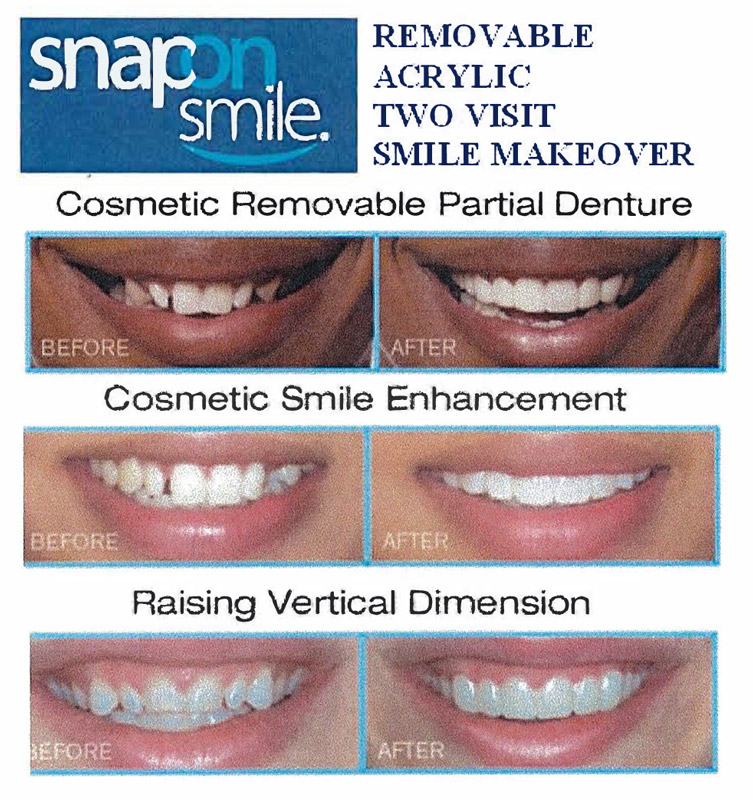 Snap-On-Smile® Infographic