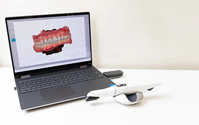iTero digital scanner used at Southern Boulevard Dental