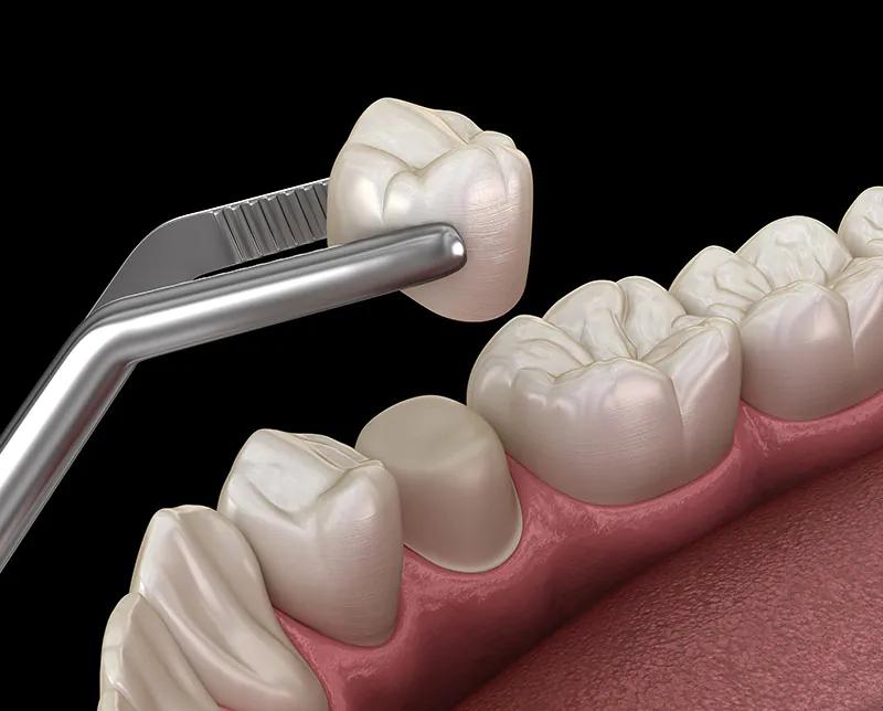 same-day dental crowns Rio Rancho, NM